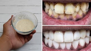CUKUP 5 MENIT, GIGI KUNING PUTIH KEMBALI DENGAN RACIKAN INI | TIPS MEMUTIHKAN GIGI DENGAN CARA ALAMI