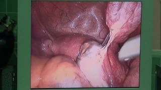 Лапароскопия. Гидросальпинкс. Трубное бесплодие.Laparoscopy. Hydrosalpinx. Tubal infertility 输卵管不育