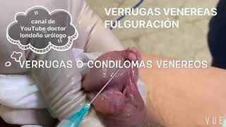 VERRUGAS TRATAMIENTO