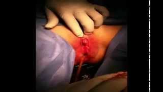 Clitoroplastia