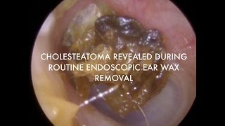 Cholesteatoma Revealed During Routine Endoscopic Wax Removal - Ep 07