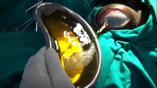 Jabouley's Procedure for Hydrocele (Hydrocelectomy)