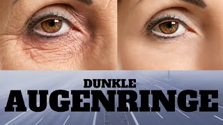 Was Hilft Gegen Augenringe - Wie man Unteraugenbeutel und dunkle Kreise Loswird