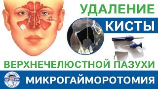 Удаление кисты верхнечелюстной пазухи  (полная операция)