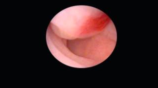 Uterus Didelphys