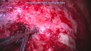 Bicoronal Craniotomy and Naso-orbital Osteotomy for Resection of the Anterior Skull Base SCC