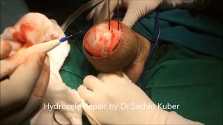 Hydrocele Surgery by Dr.Sachin Kuber MS,Pune,India Sun Clinic WA-+919370240098