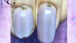 Вопрос/ответ:болезни, травмы ногтя в зоне кутикулы / Illness and injury near cuticle