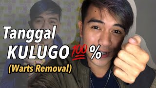 Tanggal KULUGO (warts) || 100% EFFECTIVE?
