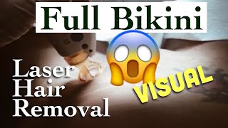 My Second Bikini Laser Hair Removal Session | FULL Visual Process