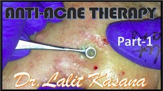 ANTI ACNE THERAPY PART  1