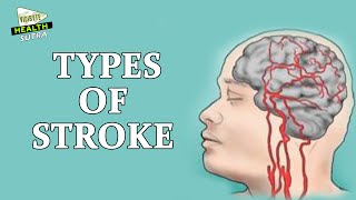 Types of Stroke