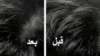 #وصفة_فعالة_للتخلص_من القشرة une recette efficace pour se debarasser des pillicules