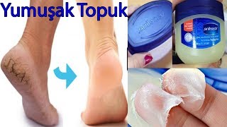 Topuk çatlaklarına çözüm bir gecede yok et mantarları azalt yumuşak topuk - Güzellik Bakım
