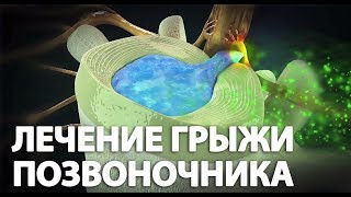 Грыжа позвоночника. Можно ли вылечить межпозвоночную грыжу без операции ?