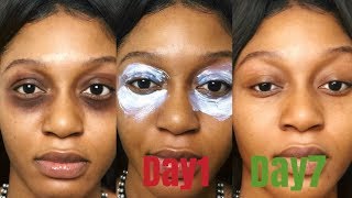 HOW TO GET RID OF DARK CIRCLE UNDER  EYES/OR DARK SPOTS FAST