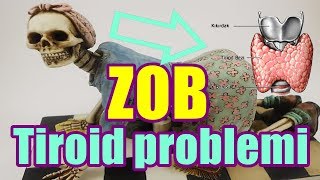 ZOB XESTELIYI. Kokelen insanlarda Tiroid problemi -Hekim mesleheti