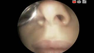 #Видео эндоскопия #носа . Острый гнойный #гайморит