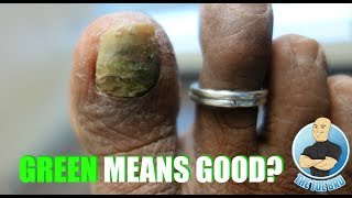 REMOVAL OF A DAMAGED GREEN TOENAIL!!!