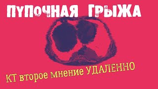 ПУПОЧНАЯ ГРЫЖА на КТ расшифровке брюшной полости с контрастированием