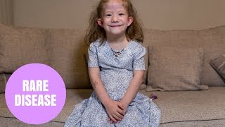 Cute Little Girl Suffers From Rare Disease