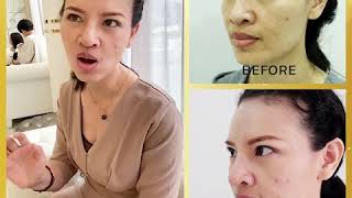 เสริมจมูก กระดูกอ่อนหลังหู by หมอทู
