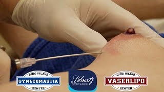 GYNECOMASTIA SURGERY Under Local ANESTHESIA‼️?