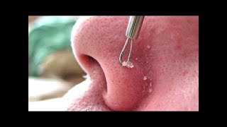 Выдавливание чёрных точек НОВОЕ! Удаление чёрных точек за ухом. p7
