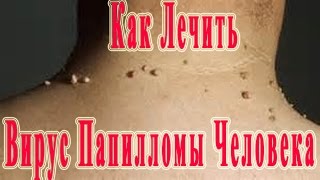 ★Вирус Папилломы Человека (кондиломы, бородавки). Как лечить? Стоит ли удалять?