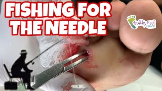 FISHING FOR THE NEEDLE IN THE FOOT, FOREIGN BODY REMOVED FROM FOOT