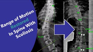 Amazing device for SCOLIOSIS restores range of motion and improves treatment without surgery