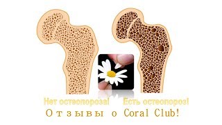 #Остеопороз (Отзывы о Coral Club)