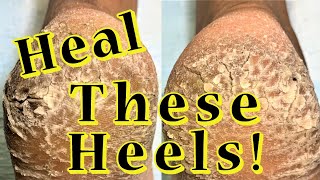 Heal These Heels!: Severe Callused and Cracked Heels