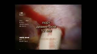 Торакоскопическое прецизионное удаление опухоли нижней доли правого легкого, интракорпоральный шов.