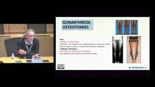 Prise en charge chirurgicale de l'arthrose du genou