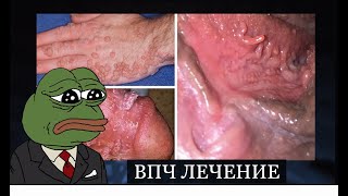 Как лечить ВПЧ