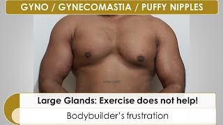 GYNECOMASTIA SURGERY | GYNO SURGERY in DELHI | Exercise Does Not Help: Dr JB Ratti VITAL CLINIC
