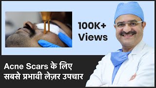 Most Effective Laser Treatment For Acne Scars(Acne Scars के लिए सबसे प्रभावी लेज़र उपचार)| (In HINDI)