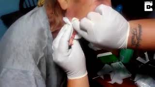 ВЫДАВЛИВАНИЕ ОГРОМНОГО ЧИРИЯ НА ЛИЦЕ У СТАРИКА!!!! 18+
