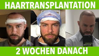 Meine Haartransplantation bei Elithairtransplant in Istanbul ? 2 Wochen danach