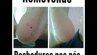 Desbastamento de Calosidades E RACHADURAS NO PÉS- Podologia