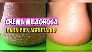 Pies y talones agrietados, nunca más con esta crema milagrosa. EcoDaisy