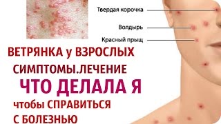 ЗАПРОС: ВЕТРЯНКА у взрослых симптомы и лечение/ Worldinside
