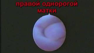 Полное удвоение матки. Удаление полипов в матке.