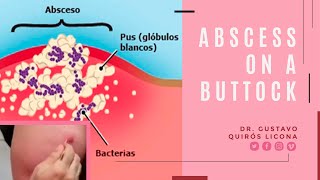 Pompa o Nalga con infección, absceso, grano o furúnculo.