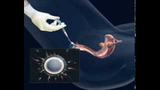 Sperm yıkama ve aşılama