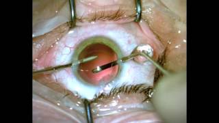 AcrySof® IQ PanOptix® trifocal intraocular lens Dr.Mishev