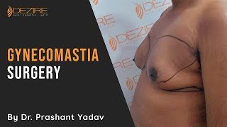 Permanent Solution for Gynecomastia | How to Fix Male Boobs | Gyno Surgery Live Video |Dezire Clinic