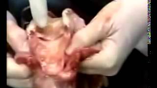 Autopsy part 2 of 2