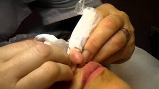 SOS ESTETISTA pulizia viso parte "2" SPREMITURA COMEDONICA